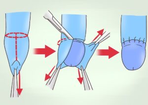 fimosis operación barcelona