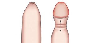 Fimosis en el pene con dificultad para retraer el prepucio – tratamiento mediante circuncisión en Barcelona