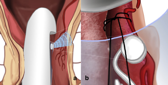 Ligadura de arterias hemorroidales con técnica DGHAL mediante Doppler