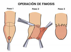 Pasos de la operación de fimosis con circuncisión, eliminación del prepucio y sutura final en Barcelona